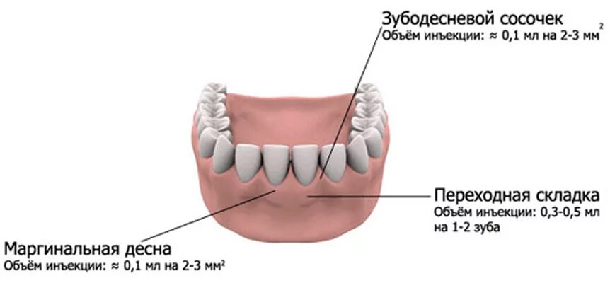 Введение плазмы в Десна. Плазмолифтинг стоматология Десна. Пепеходная складка ЗУ.А. Где находится десна