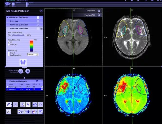 Мрт перфузия. Перфузионная компьютерная томография головного мозга. Кт перфузия головного мозга методика. Кт перфузия головного мозга при ишемическом. Мрт перфузия.
