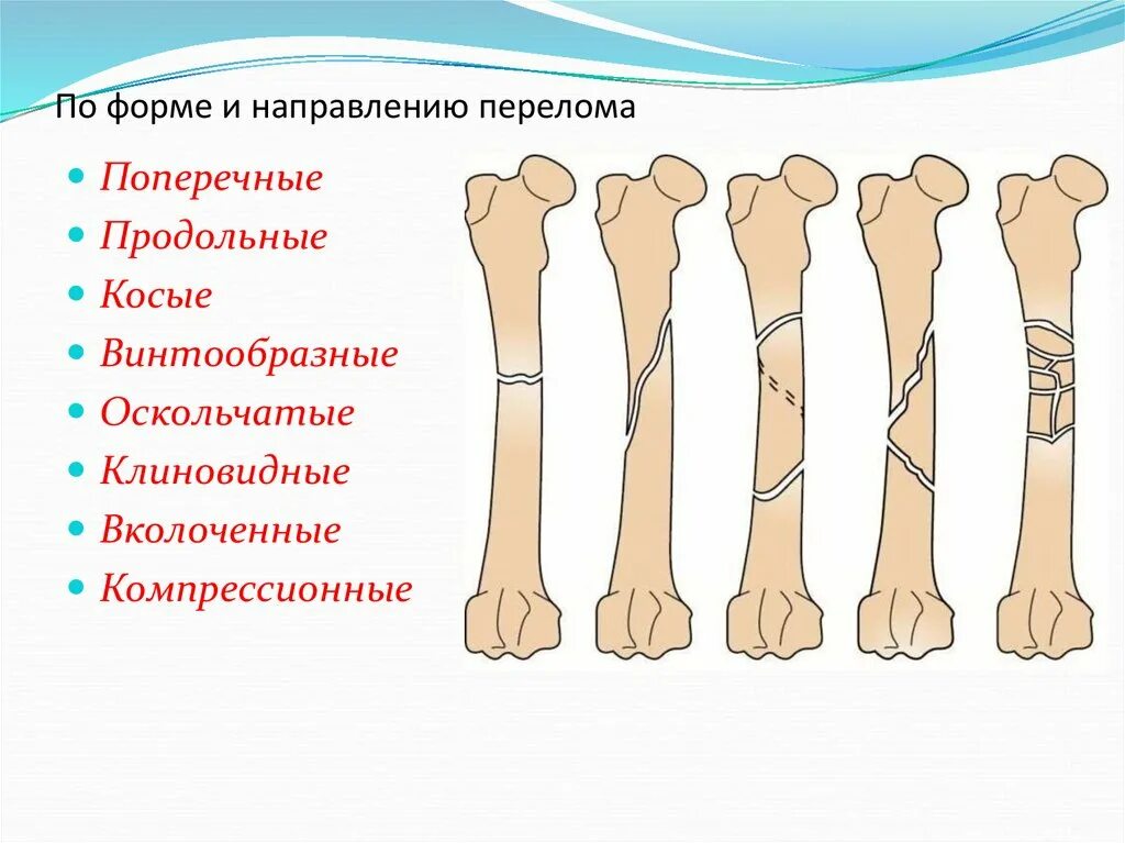 Перелом кости может быть каким. Классификация переломов по направлению линии перелома. Классификация переломов по линии излома. Классификация переломов по характеру повреждения кости. Классификация переломов костей конечностей.