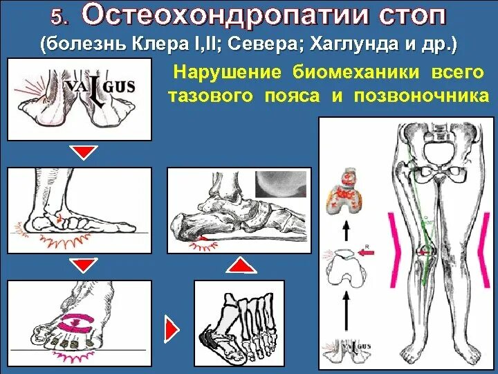 К нарушениям опорно двигательного аппарата относят. Остеохондропатии стопы. Болезнь Хаглунда севера. Опорно двигательный аппарат стопы.