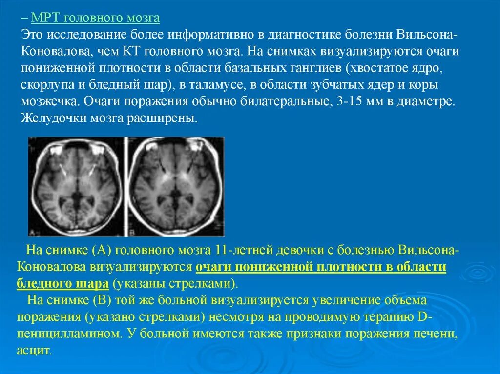 Кт головного мозга болезнь Вильсона. Мрт головного мозга при болезни Вильсона Коновалова. Болезнь Вильсона Коновалова мрт. Болезнь Вильсона Коновалова кт. Поражение головного мозга болезнь