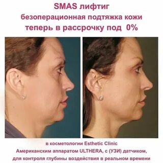 Смаса 1