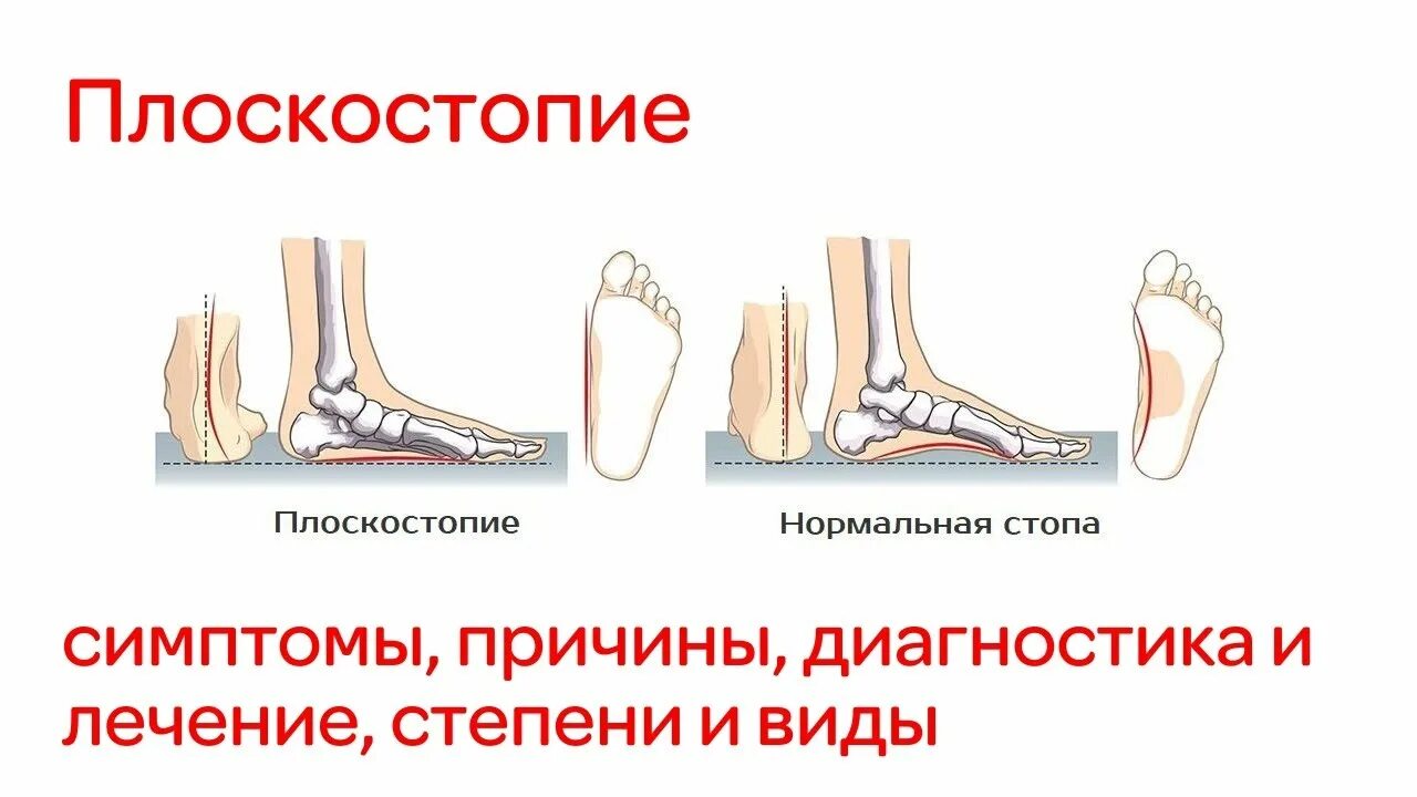 Поперечное 1 степени. Продольно-поперечное плоскостопие и вальгус 3 степени. Продольное поперечное и комбинированное плоскостопие. Симптомы плоскостопие 3й степени. Продольное плоскостопие 2 степени.