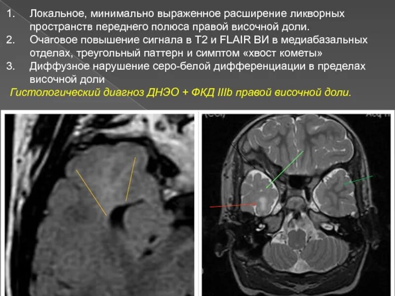 Наружные и внутренних ликворных пространств. Расширение ликворных пространств мрт. расширение наружных ликворных пространств. расширение наружных ликворных пространств мозжечка. расширение наружных ликворных пространств на мрт.