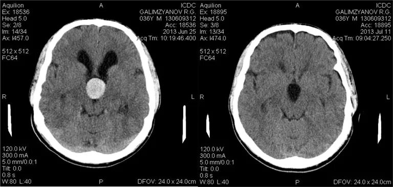 Коллоидная киста 3 желудочка мрт. Кистозная опухоль головного мозга кт. Коллоидная киста третьего желудочка на кт. Киста третьего желудочка головного мозга.