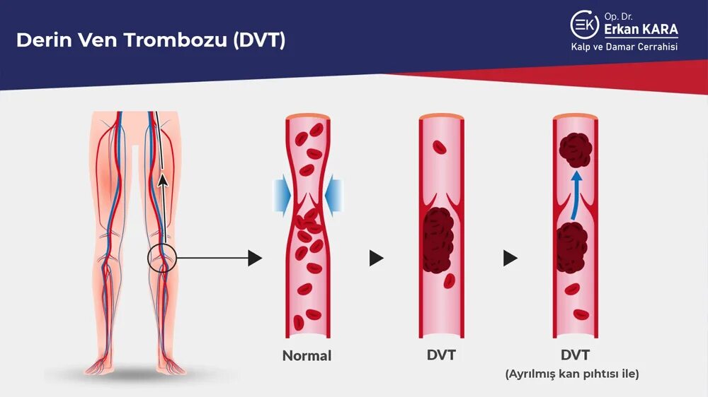 Глубокий венозный тромбоз. Артериальный тромбоз клиника. Как снизить тромбоз