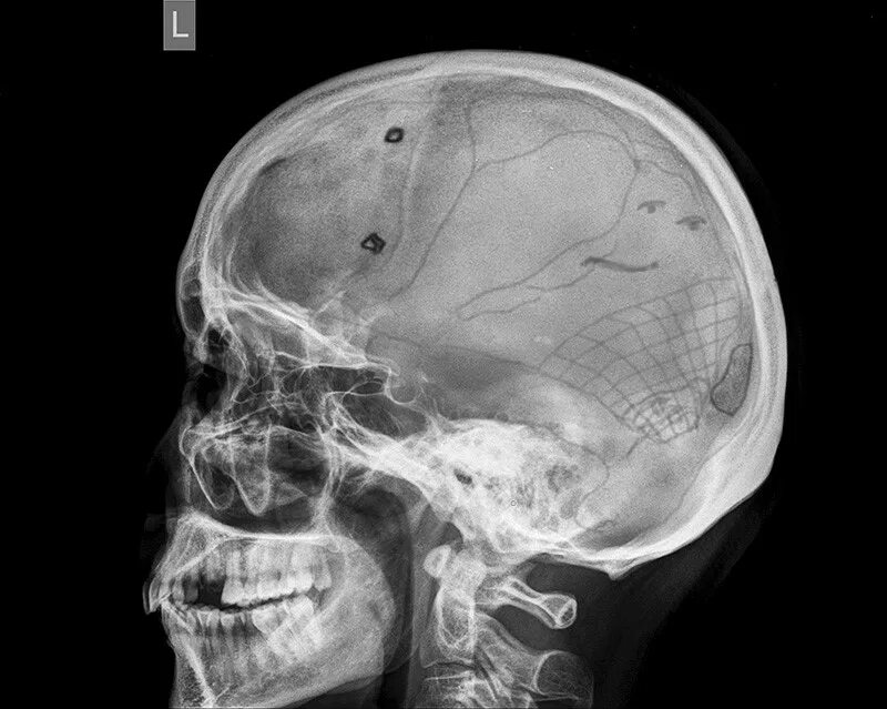 Кости черепа рентген. Рентген черепа в боковой проекции норма. Кости черепа рентген норма. Норма костей черепа на рентгене. Гиперостоз лобной кости рентген.