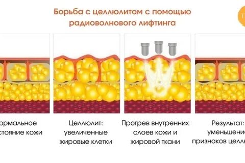 Воспаление жировой ткани