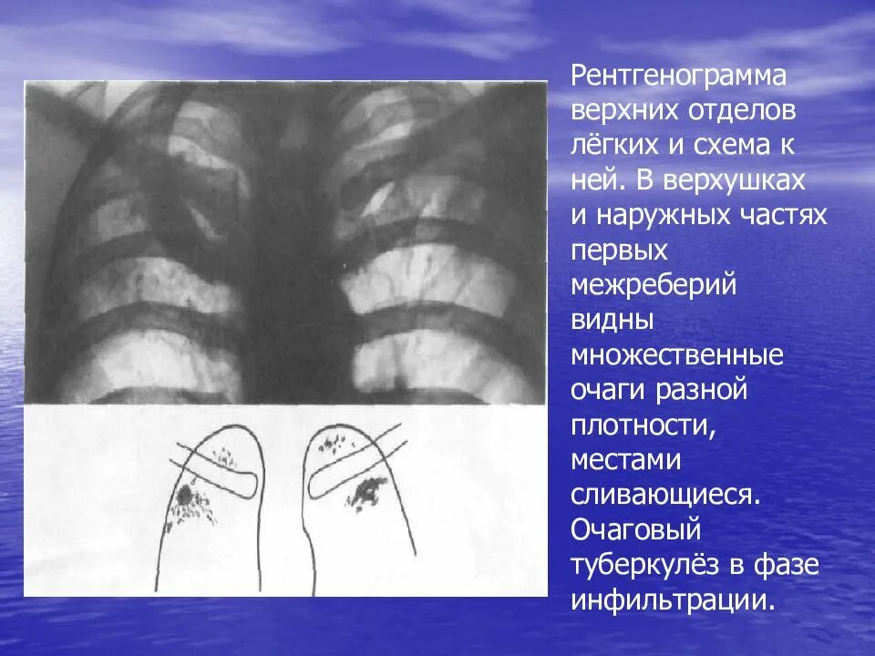 Очаговый туберкулез рентгенограмма. Очаговый туберкулез верхушки левого легкого схема. Схема легких на рентгенограмме.