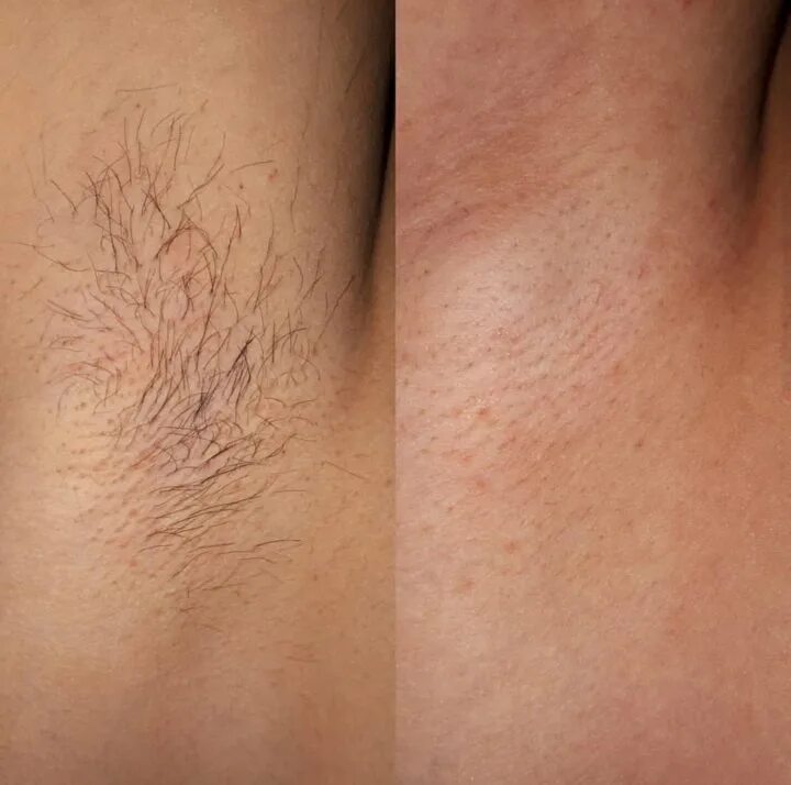 мужская эпиляция. депиляция шугаринг бикини. эпиляция бикини до и после. шугаринг глубокое бикини до и после. мужская эпиляция интимных зон.