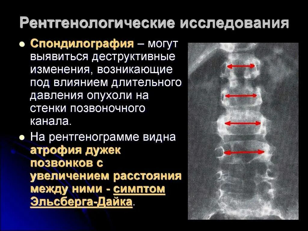 Остеохондроз поясничного отдела позвоночника периоды. Опухоль спинного мозга на рентгене позвоночника. Функциональное рентгенологическое исследование поясничного отдела. Синдромы остеохондроза поясничного отдела. Функциональные рентгенограммы поясничного отдела позвоночника.