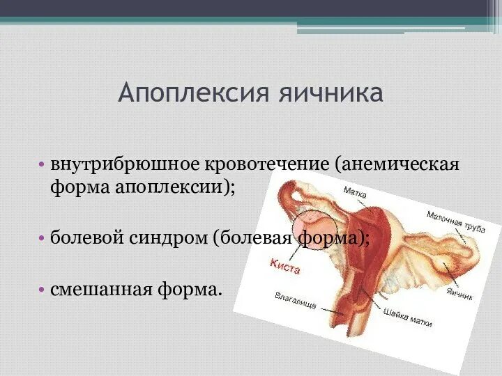 Апоплексия яичника болевая форма. Апоплексия яичника анемическая форма. Апоплексия болевая форма. Апоплексия яичника внутрибрюшное кровотечение.