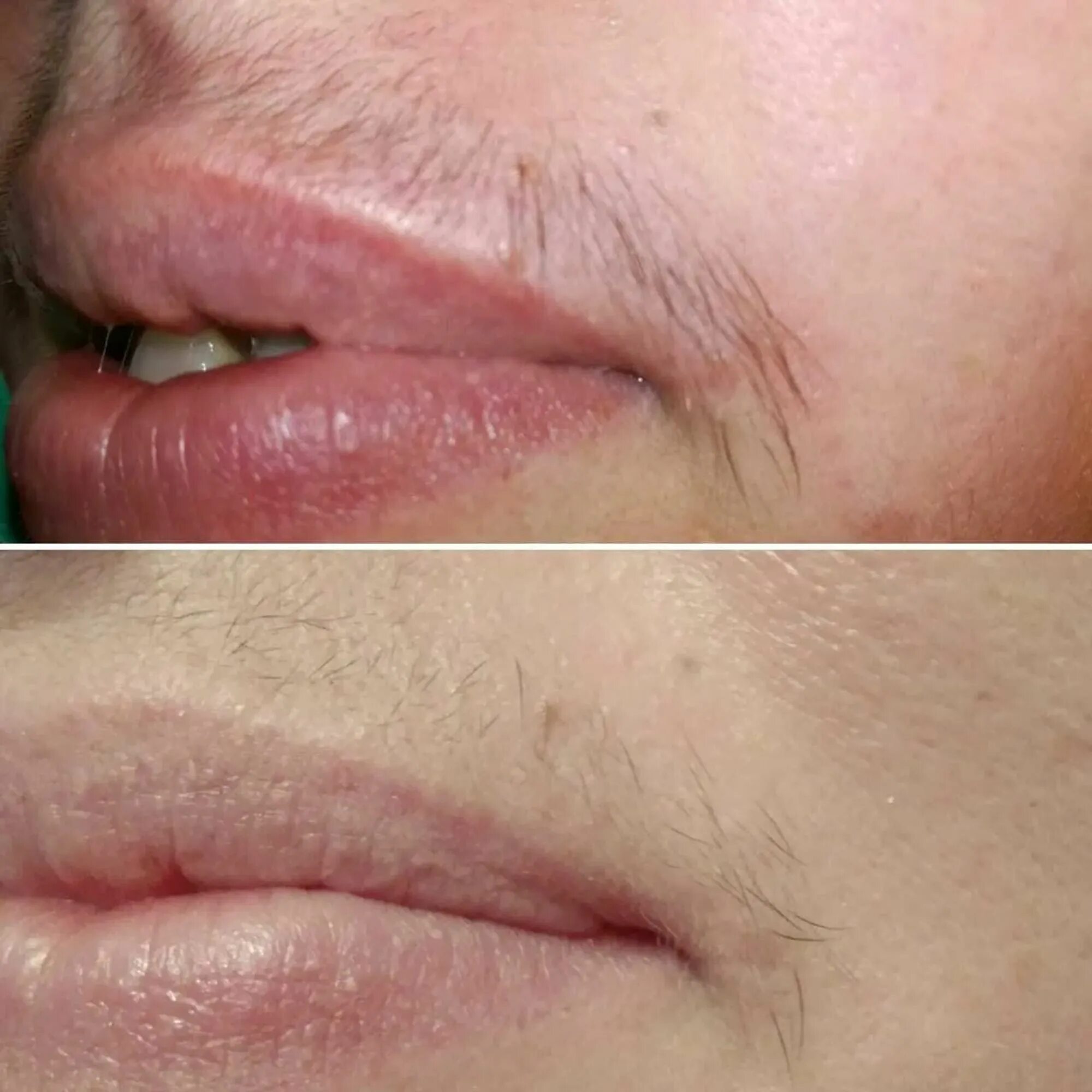 Убрать усики над губой ниткой. Лазерная эпиляция волос над верхней губой. Обесцвечивание усиков. Усики над верхней губой. Женские усики над верхней губой.