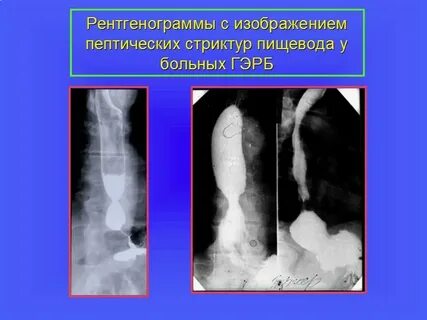Стеноз пищевода