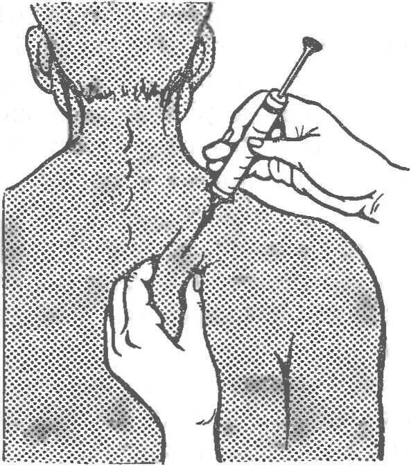 Укол под лопатку от чего. Техника подкожной инъекции в подлопаточную область. Техника введения АДСМ под лопатку. Постановка прививки АДСМ под лопатку. Прививка АДСМ под лопатку.