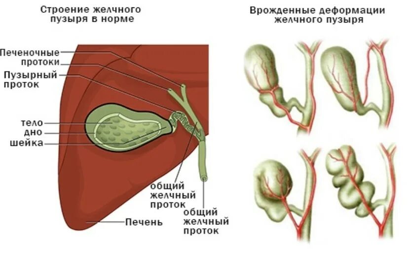 Желчном пузыре что бывает. S образный Перегиб желчного пузыря. Деформированный желчный пузырь. Желчный пузырь грушевидной формы. Форма желчного пузыря с перегибом.