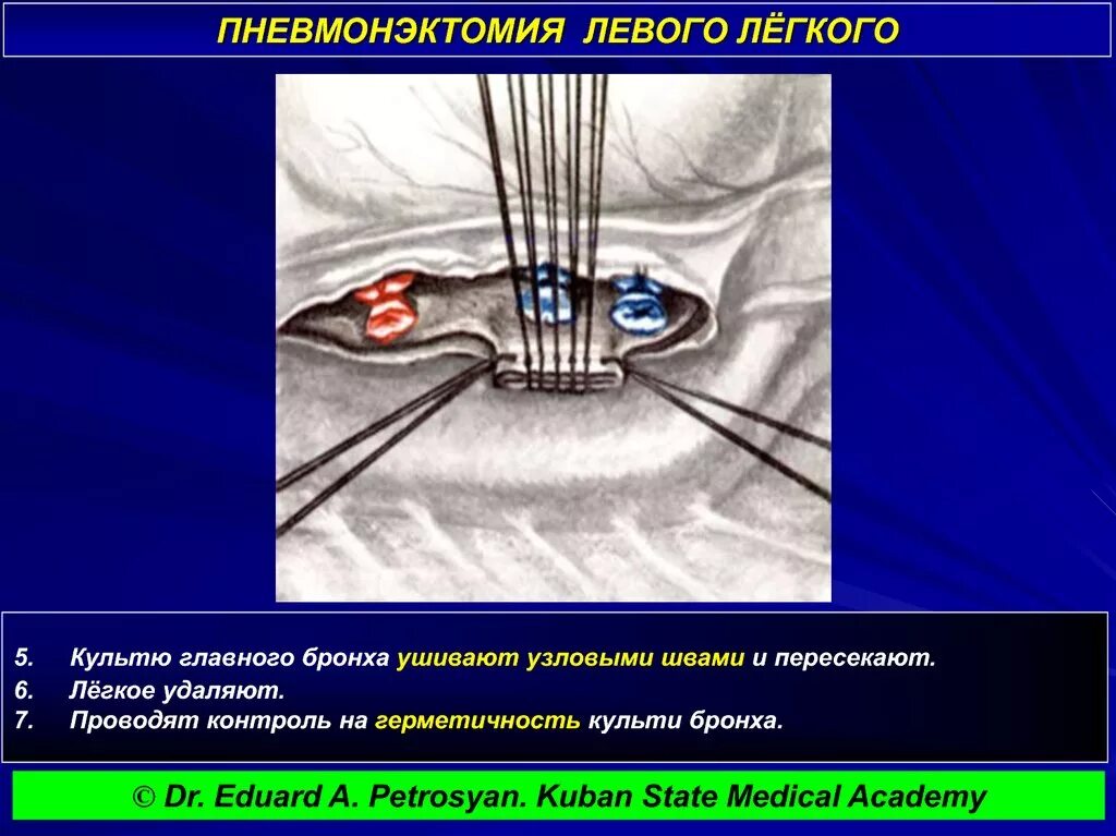 Пневмонэктомия топографическая анатомия. Пневмонэктомия этапы операции. Пульмонэктомия техника операции. Этапы операции на легком. Операция левого легкого