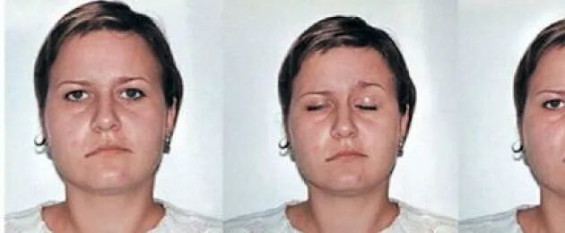 Повреждение нервов лица