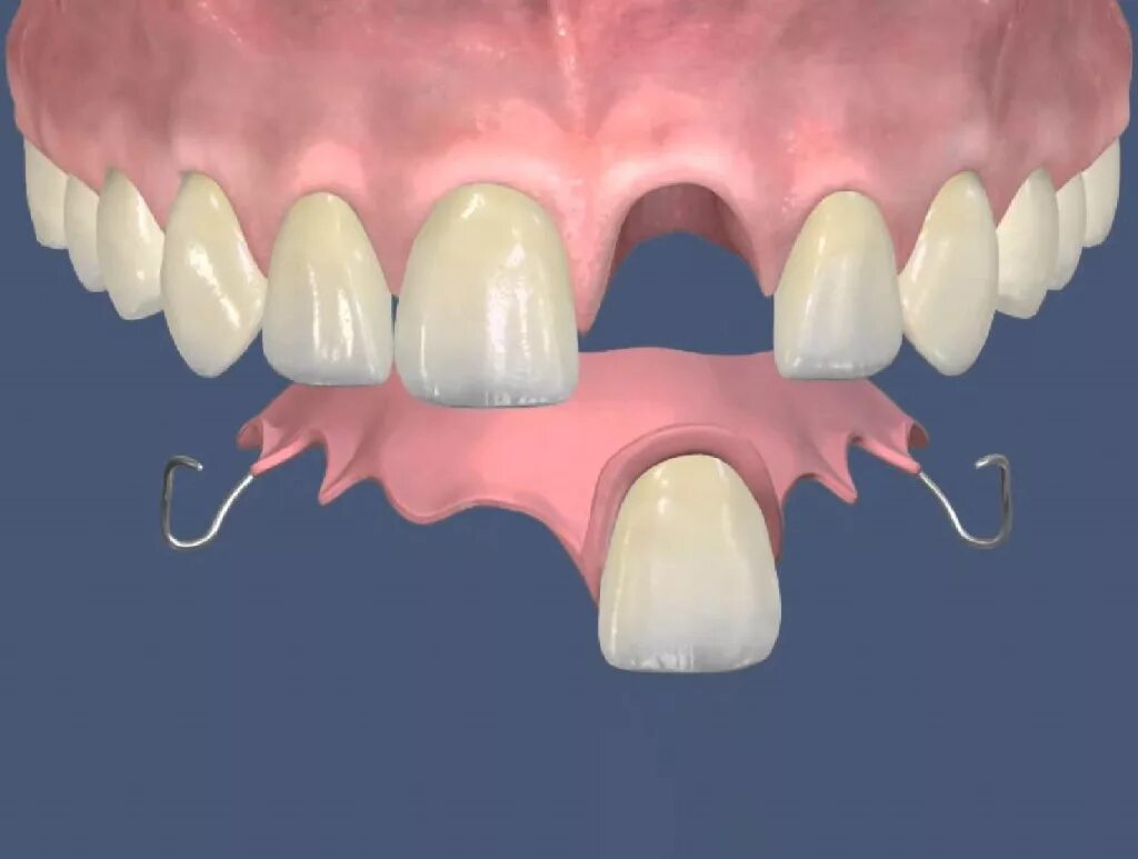 Съемный микропротез 1 зуб. Несъемные иммедиат-протезы. Съемный микропротез «бабочка». Микропротез бабочка на 1. 3 зуба установить