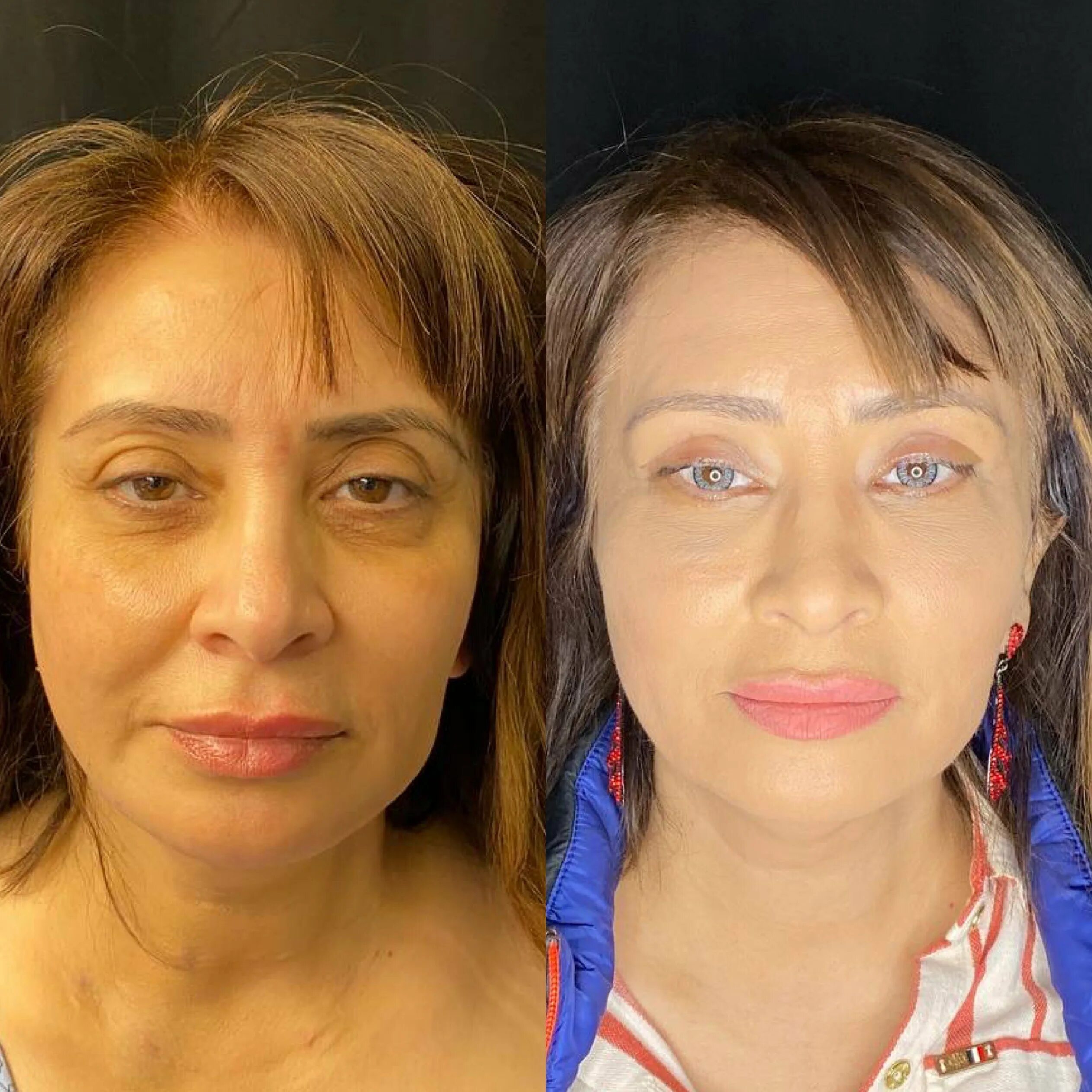 Блефаропластика операция в Киеве на Печерске - Coolaser Clinic Растяжки, Кинозве