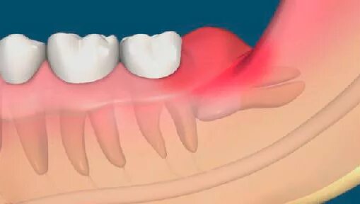 Гнойный перикоронарит. Парадентальная киста челюсти. Конец зуба. Конец зуба. Фиссурный кариес средний.