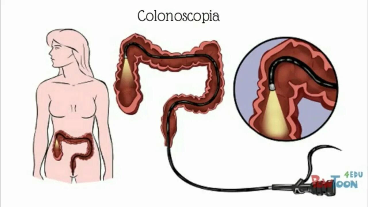 Эндоскопическое исследование толстой кишки колоноскопия. Ректоскопия, ректороманоскопия, колоноскопия. Колоноскопия Толстого кишечника. Эндоскопия Толстого кишечника (колоноскопия),. Как правильно вставить кишку