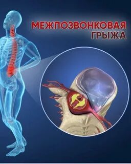 Грыжа екатеринбург