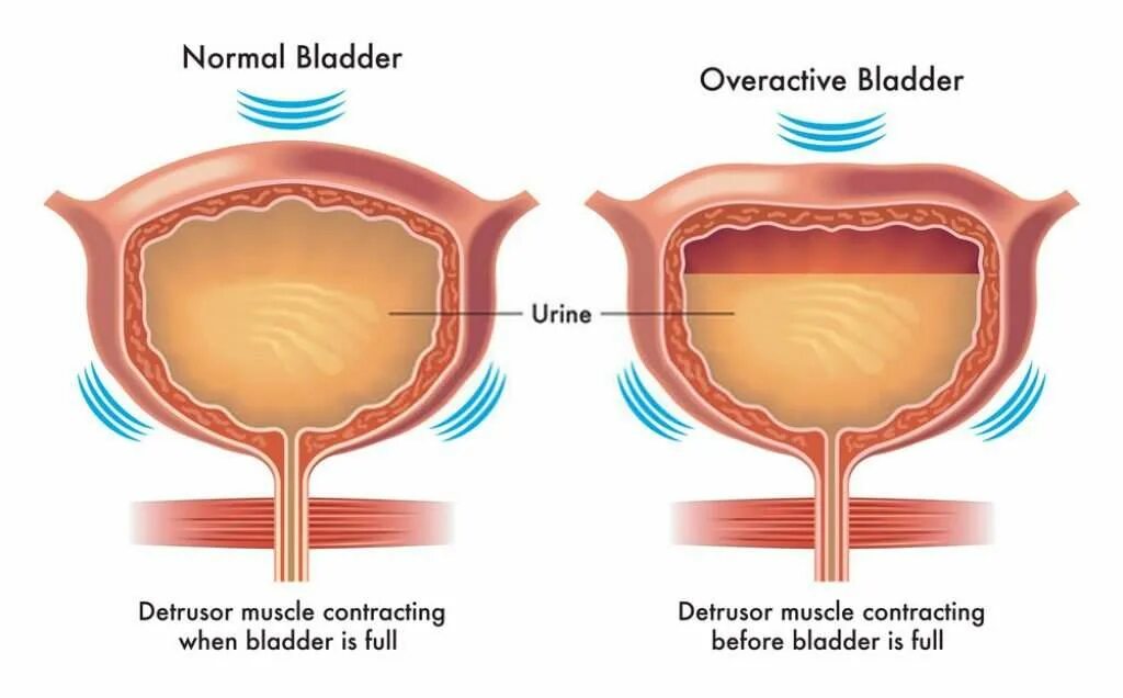 Мочевой пузырь у мужчин и женщин. Overactive bladder. Мочевой пузырь. Детрузор. Гипоактивный мочевой пузырь.