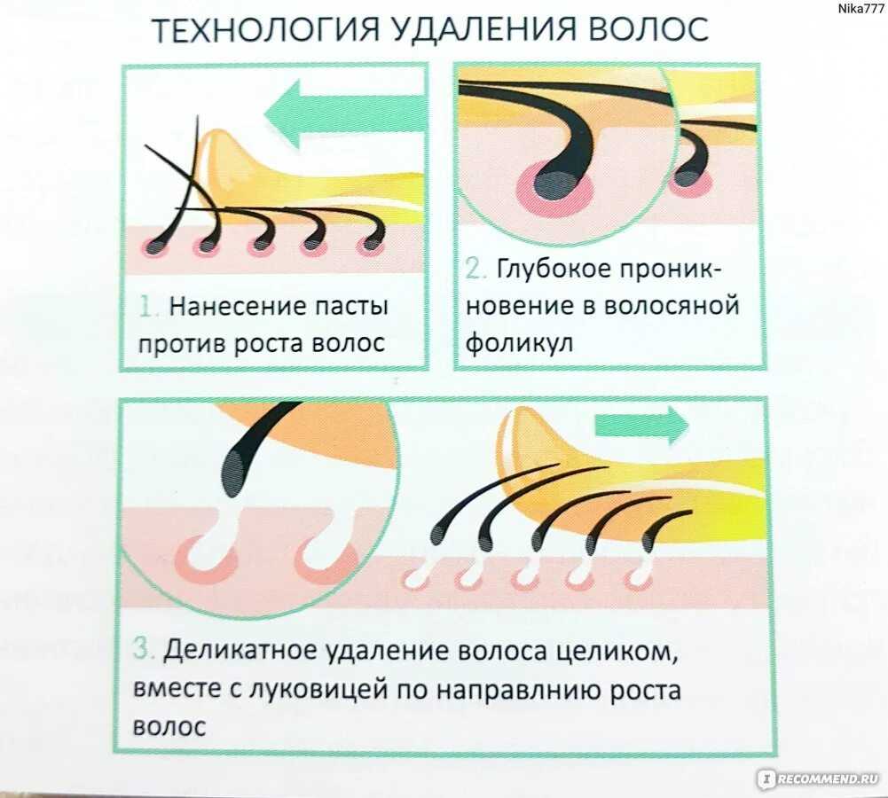 Шугаринг по росту волос. Бритье по направлению роста волос. Направление роста волос для депиляции. Схемы нанесения шугаринга. Депиляция воском против роста или по росту