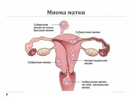 Миома тела матки что это