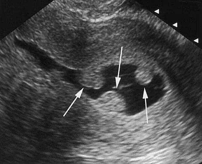 Узи протокол разрыв кисты яичника. Миома матки узи заключение. Изменения в малом тазу. Изменения в малом тазу. Изменения в малом тазу.