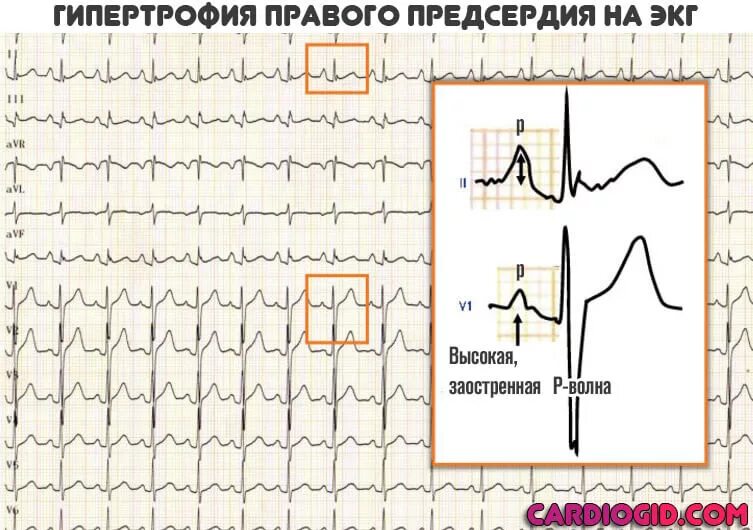 Гипертрофия правого предсердия на ЭКГ. Гипертрофия миокарда предсердий ЭКГ. Гипертрофия правого и левого предсердия на ЭКГ. Признаки гипертрофии правого предсердия на ЭКГ. Перегрузка на экг что это