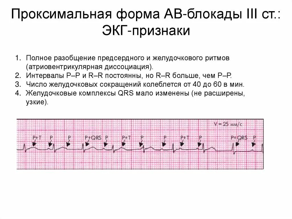 Атриовентрикулярная блокада 2. Атриовентрикулярная блокада типа Мобитц 2. ЭКГ при АВ блокаде 2 степени. Атриовентрикулярная блокада на ЭКГ. Атриовентрикулярная блокада II степени Мобитц Тип 2 характеризуется:.