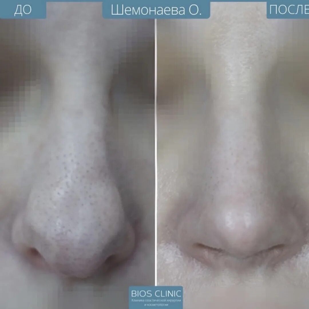 Ринопластика горбинки носа. Гасан ашаханович риносептопластика. Нос мужчины. Круглый кончик носа. Опускание кончика носа.