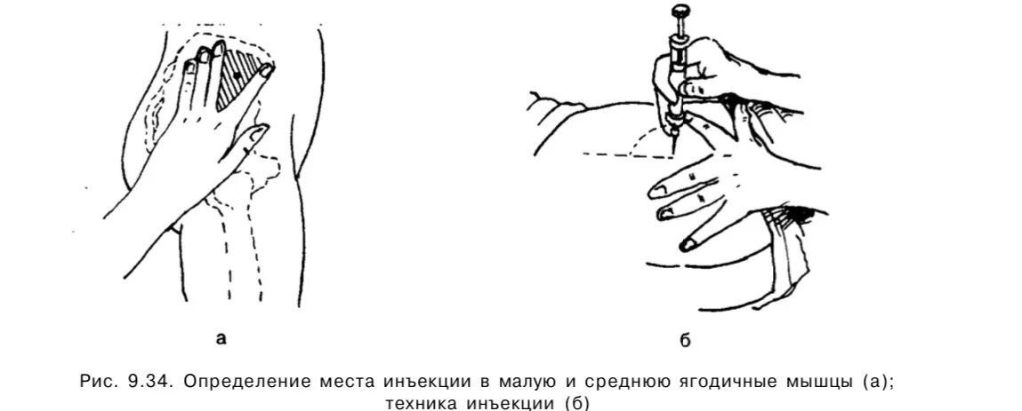 Внутримышечная инъекция верхний Квадрант. Техника постановки внутримышечной инъекции в ягодицу. Внутримышечный укол в бедро техника. Техника укола в ягодичную мышцу. Как часто можно делать уколы внутримышечно