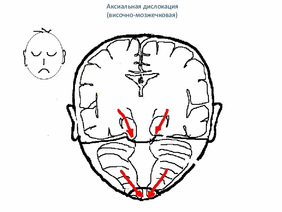 Миндалины мозжечка выше уровня