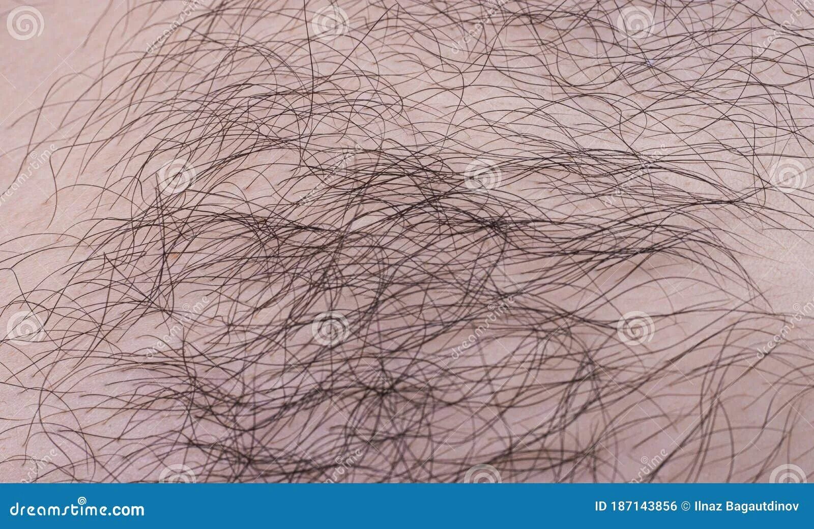 У девочки растут лобковые волосы. У девочки растут лобковые волосы. У девочки растут лобковые волосы. Лазерная депиляция бикини. Заросли лобковых волос.