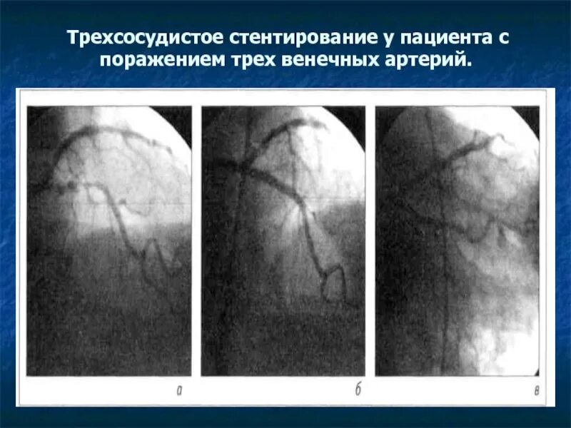 Диффузное поражение артерий. Трехсосудистое поражение коронарных артерий. трехсосудистре поражение артерии. трехсосудистое поражение коронарного русла что это. многососудистое поражение сердца.
