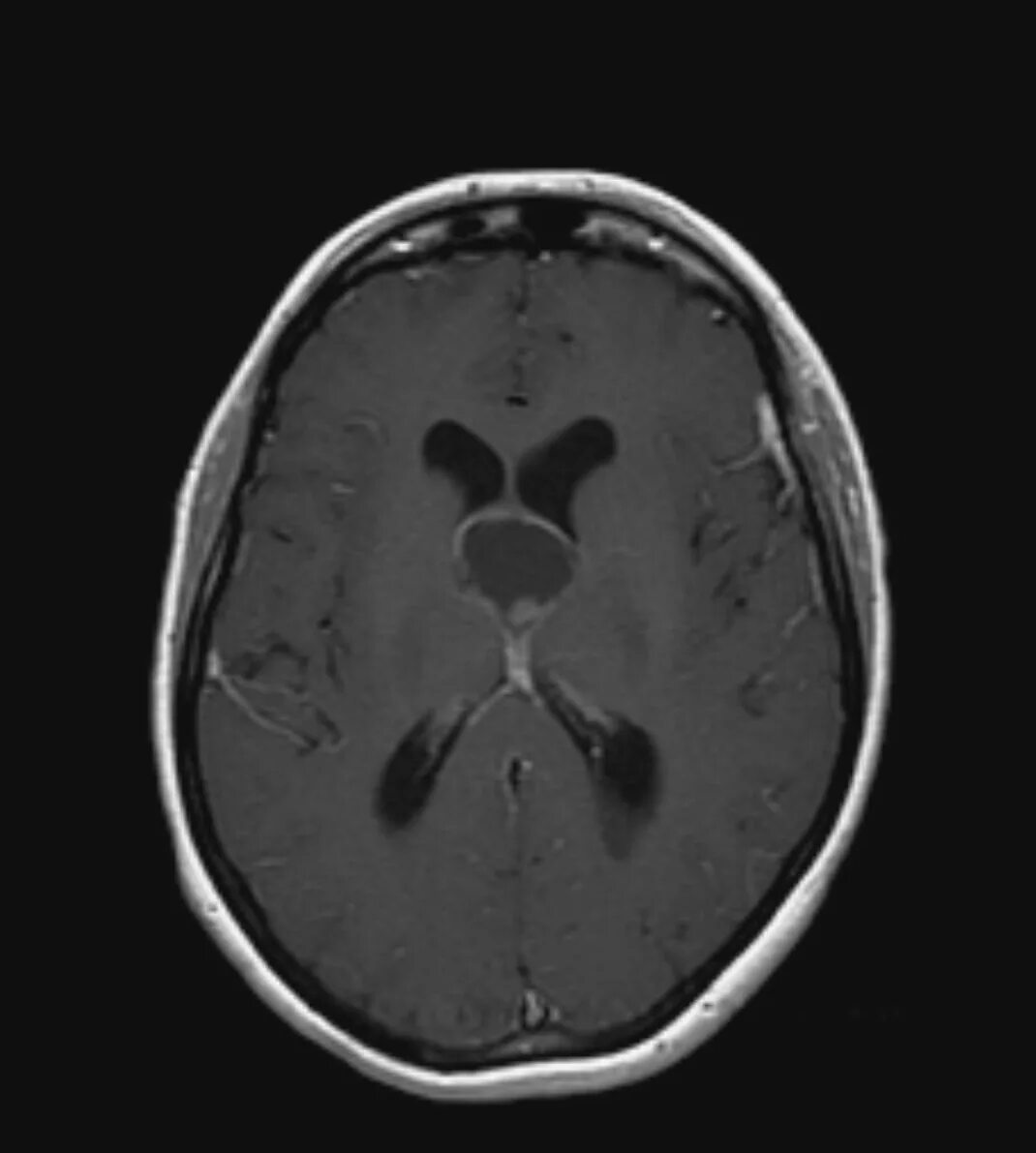 Коллоидная киста 3 желудочка кт. Коллоидная киста 3 желудочка мрт. Коллоидная киста головного мозга. Коллоидная киста головного мозга на кт.