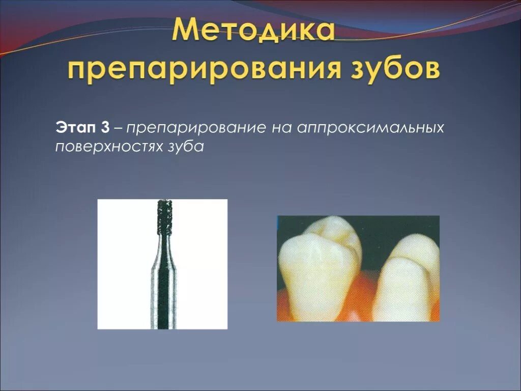 Принципы препарирования твердых тканей зуба. Этапы препарирования зуба. методика препарирования зуба.
