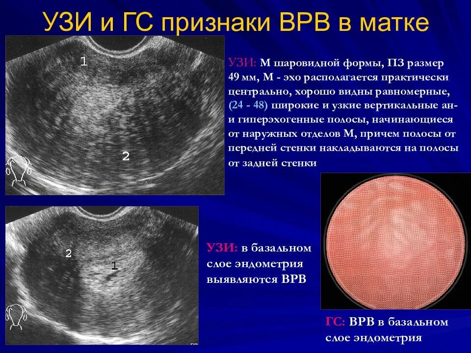 Шаровидная форма матки.