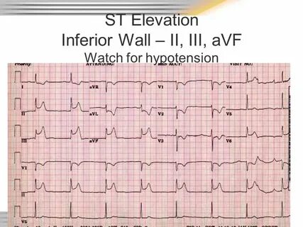 Ii iii avf