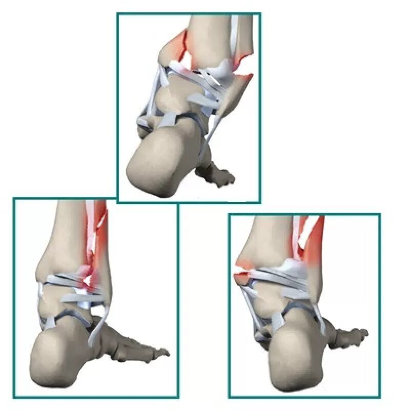 Перелом голеностопного сустава. Перелом лодыжек голеностопного сустава. Подвывих голеностопного сустава классификация. Травма голеностопа перелом. Перелом лодыжки растяжение связки.