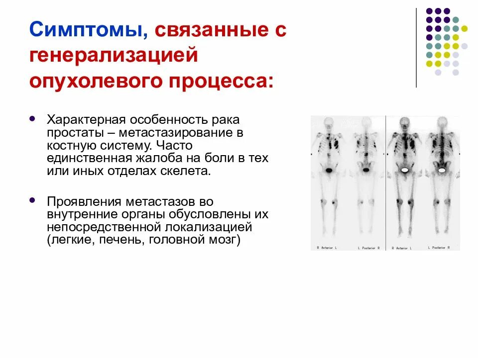 Как проявляется рак простаты симптомы