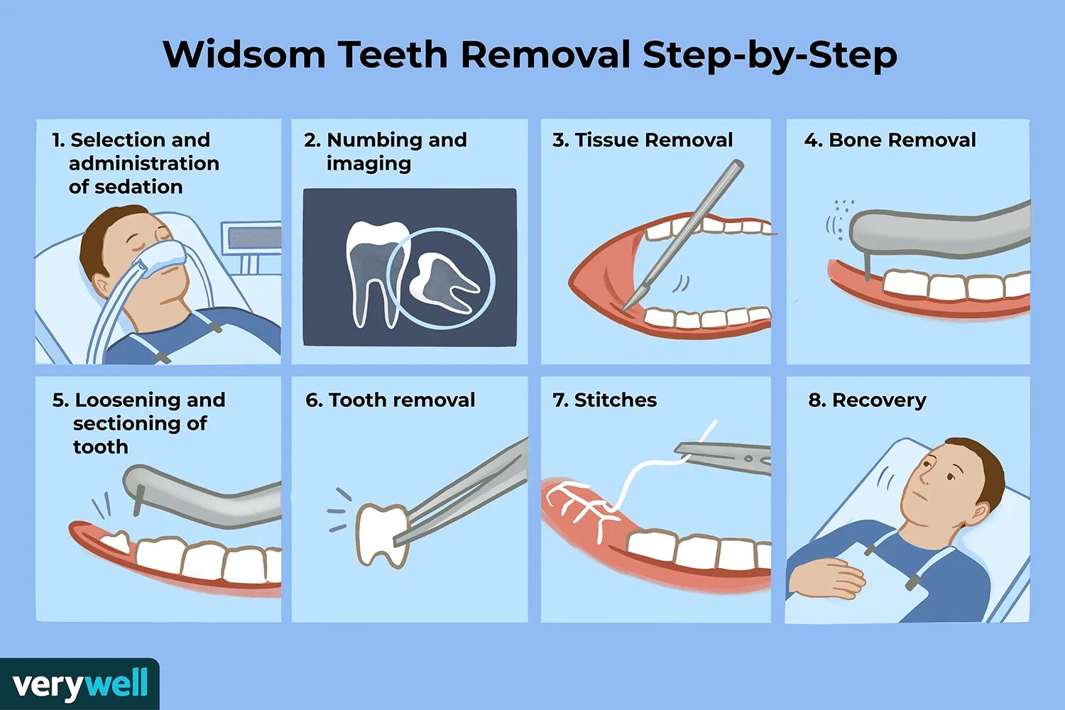 Можно курить после стоматолога. Как удаляют зуб мудрости. Удаленные зубы мудрости. Резекция зуба мудрости. Зуб мудрости оперировали.