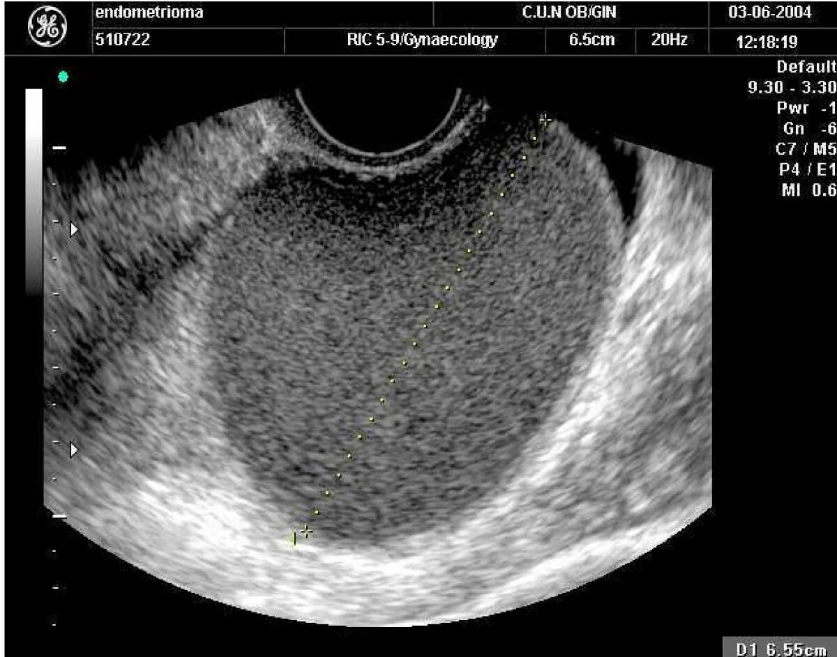 Признаки внутреннего эндометриоза на узи. УЗИ картина внутреннего эндометриоза.