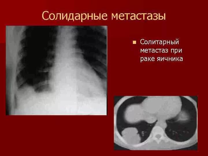 Рак метастазы в надключичных. Крукберовский метастаз. как выглядят метастазы в органах. солитарный опухоли легких.