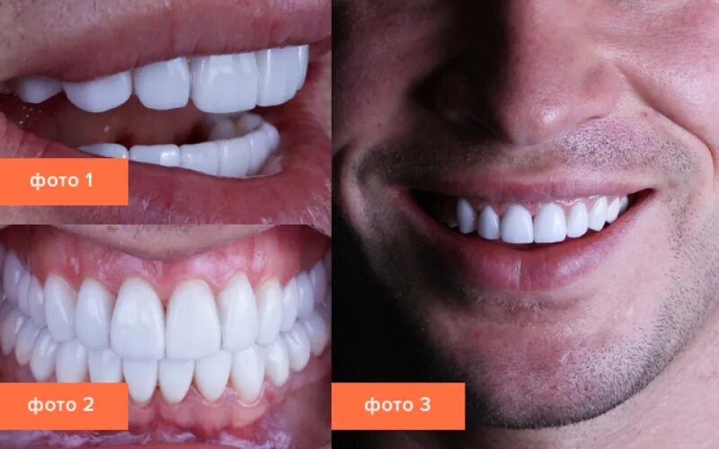 Виниры на два зубы. Виниры на два зубы. Виниры на два передних зуба. Композитные накладки на зубы. Виниры на два зубы.