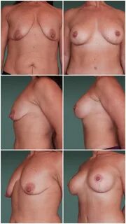 Breast Augmentation and Lift br.