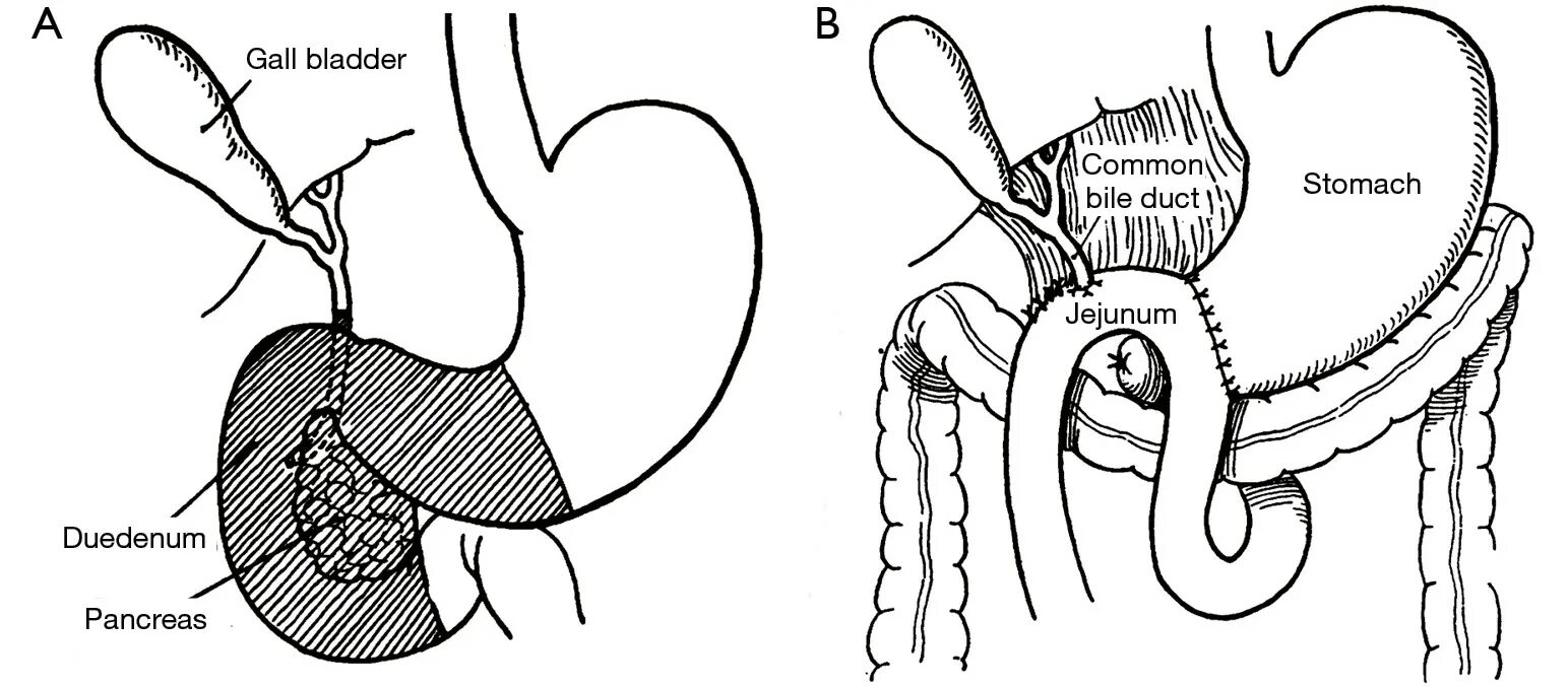 Овсянка поджелудочная железа. Овсяная крупа для диабетиков. Овсянка поджелудочная железа. Питания для больных язвой желудка. Диетическое питание каши.